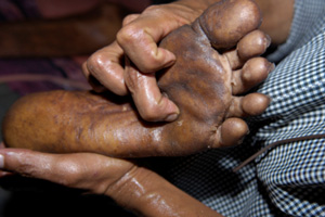 Varman massage of foot
